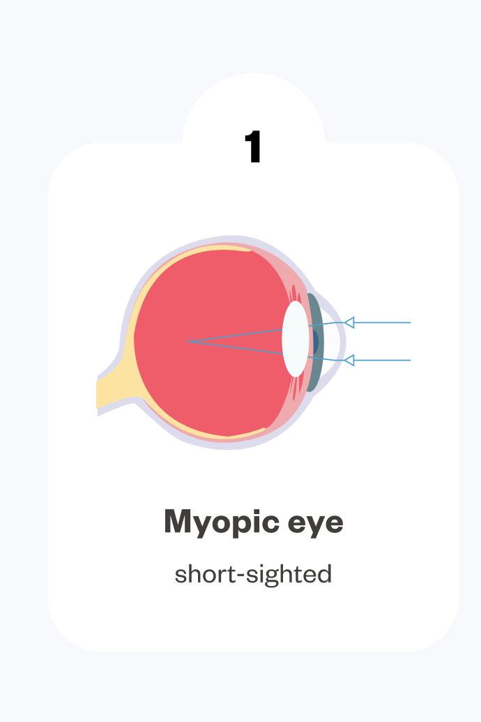 ortho-k-how-it-works-slider-myopia-eye